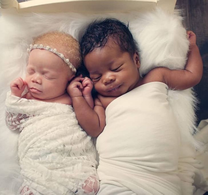 gemeos2 - Gêmeos de tons de pele diferentes arrebatam mãe no nascimento