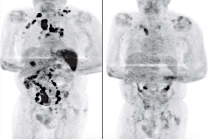 revistacarpediem.com - O estranho caso do homem que foi curado de câncer linfático após contrair Covid-19